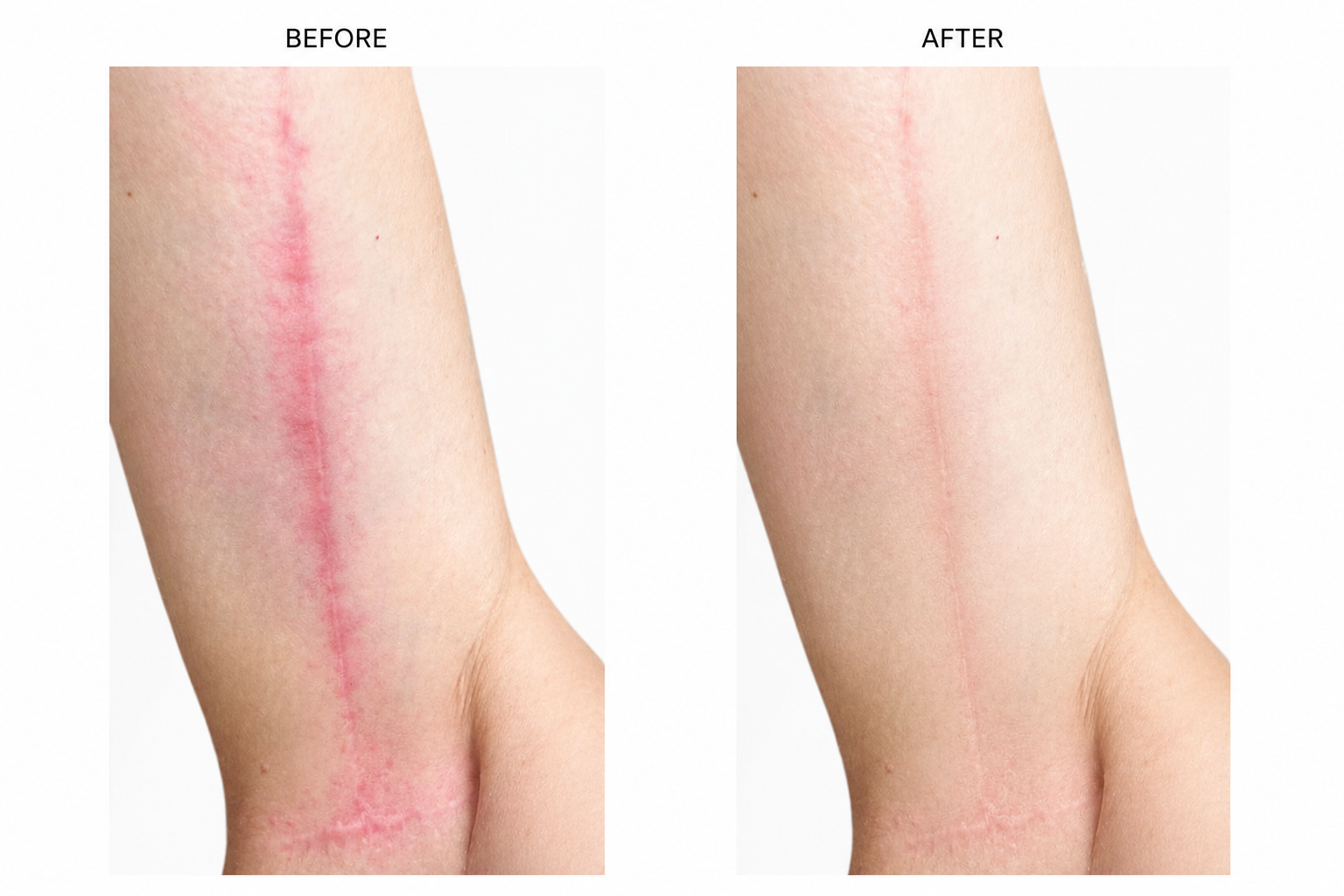 Scar Revision Before &amp; After: Significant Improvement After 4 Treatments