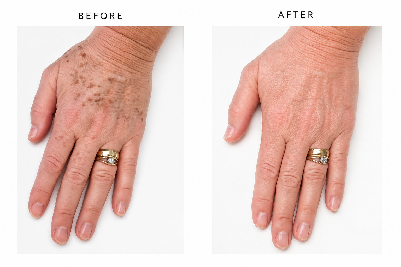 Lumecca IPL: Transform Sun-Damaged Skin with Advanced Intense Pulsed Light Technology