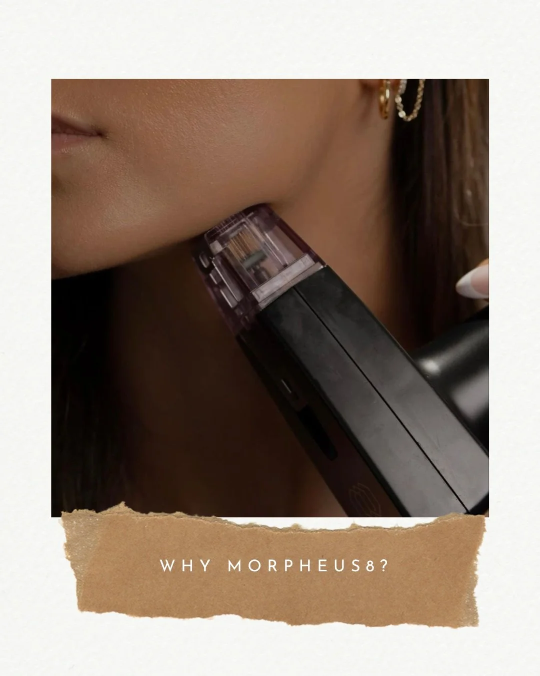 ✨

Morpheus8 combines microneedling with radiofrequency energy to stimulate collagen and improve the appearance of:

&bull; Fine lines and wrinkles
&bull; Uneven texture
&bull; Acne scars
&bull; Skin laxity
&bull; Jawline and facial contours

Ready t