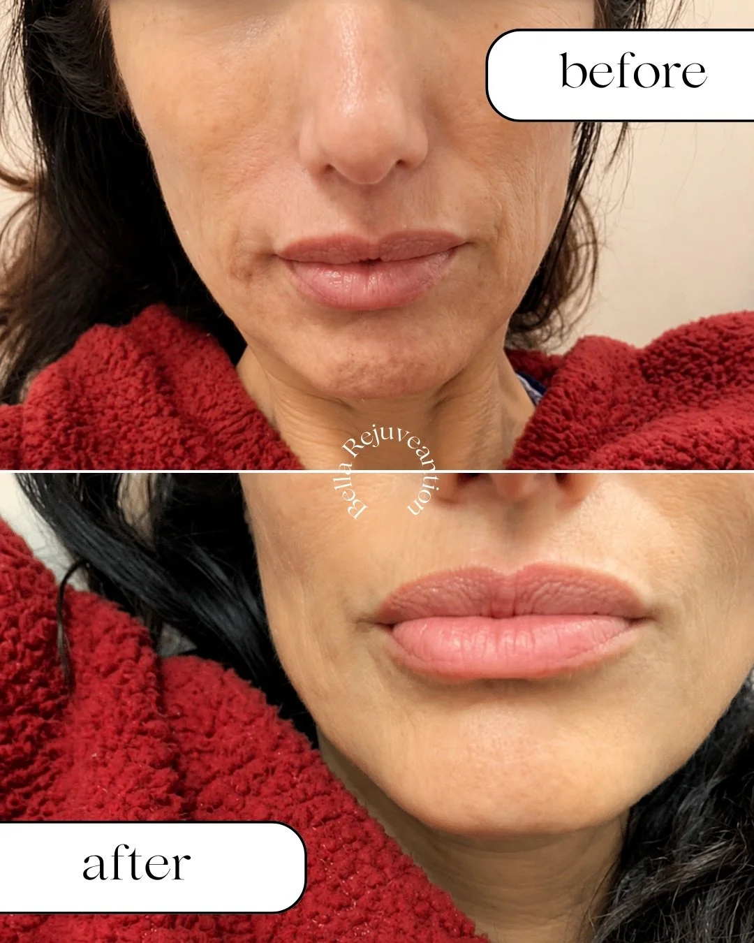 Subtle enhancement, beautifully customized ✨

Every lip filler treatment begins with a thorough consultation with our experienced RN Michele. She takes the time to understand your goals, assess your natural features, and create a personalized treatme