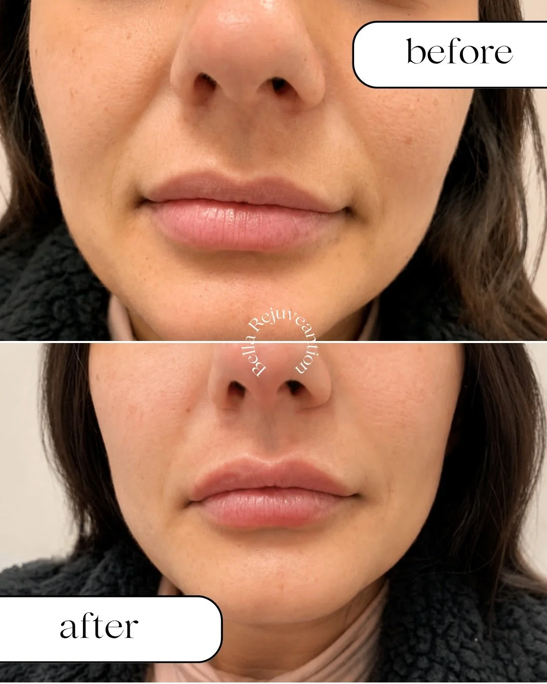 A little enhancement, a beautiful difference 💋✨

This before-and-after shows how thoughtfully placed lip filler can enhance shape, balance and definition while keeping the results soft and natural-looking.

Every treatment is customized to your feat