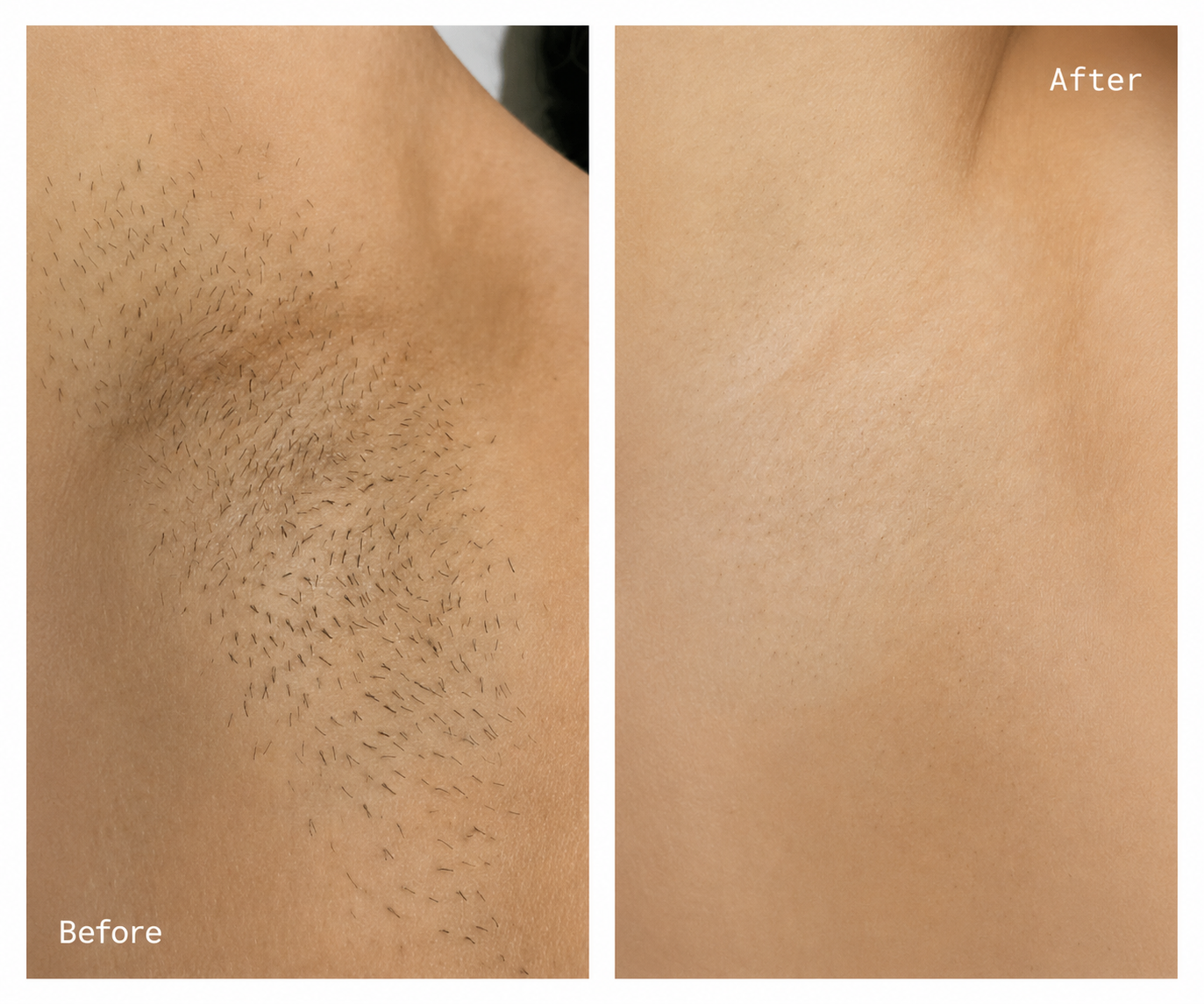 Side-by-side comparison of underarm hair removal, showing before and after results; the left side labeled 'Before' displays underarm hair, while the right side labeled 'After' shows smooth, hairless skin.