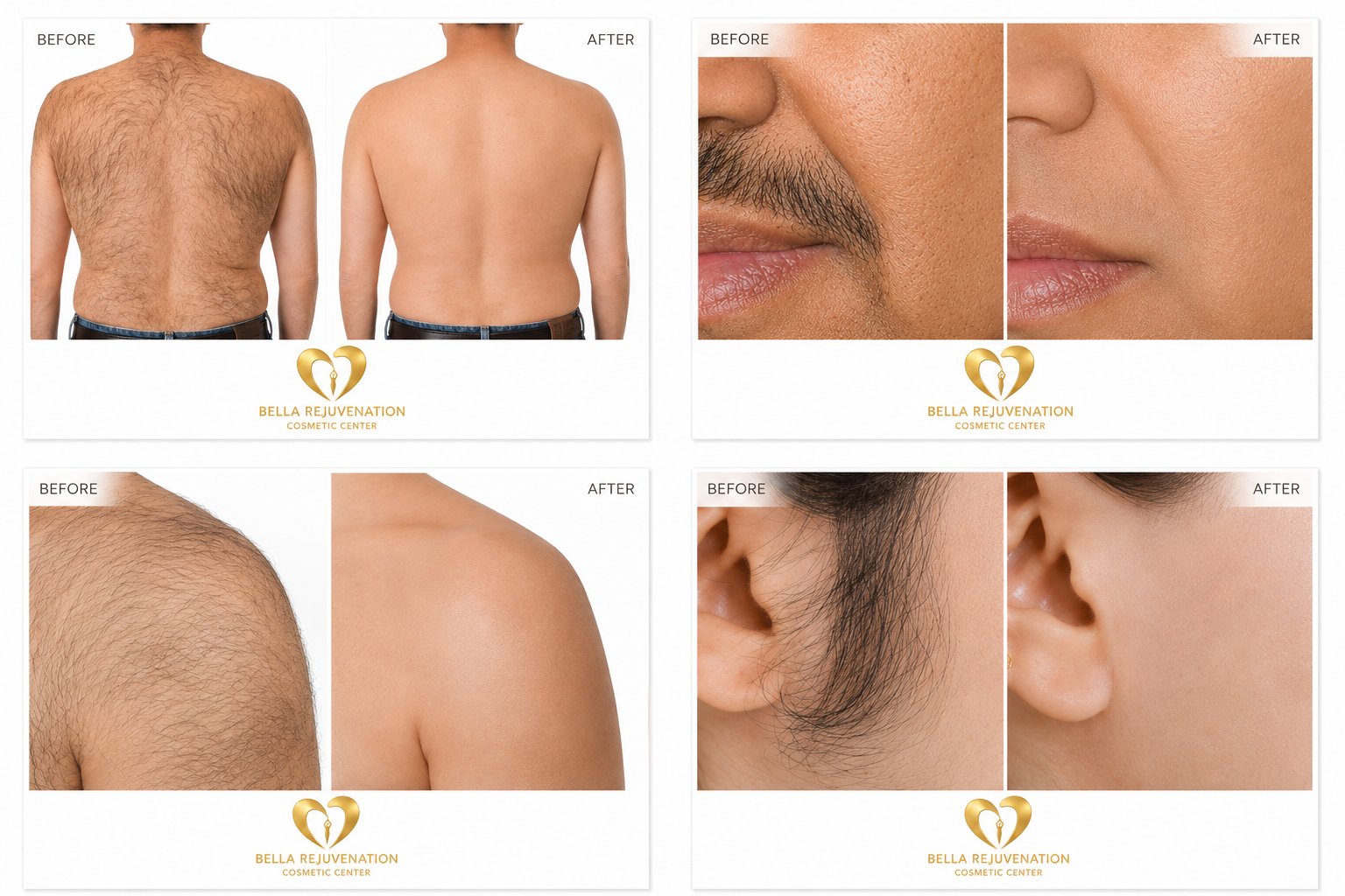 Before and after photos showing hair removal results on the back, face, shoulder, and neck, with the text 'BEFORE' and 'AFTER' labels and the logo of Bella Rejuvenation Cosmetic Center.