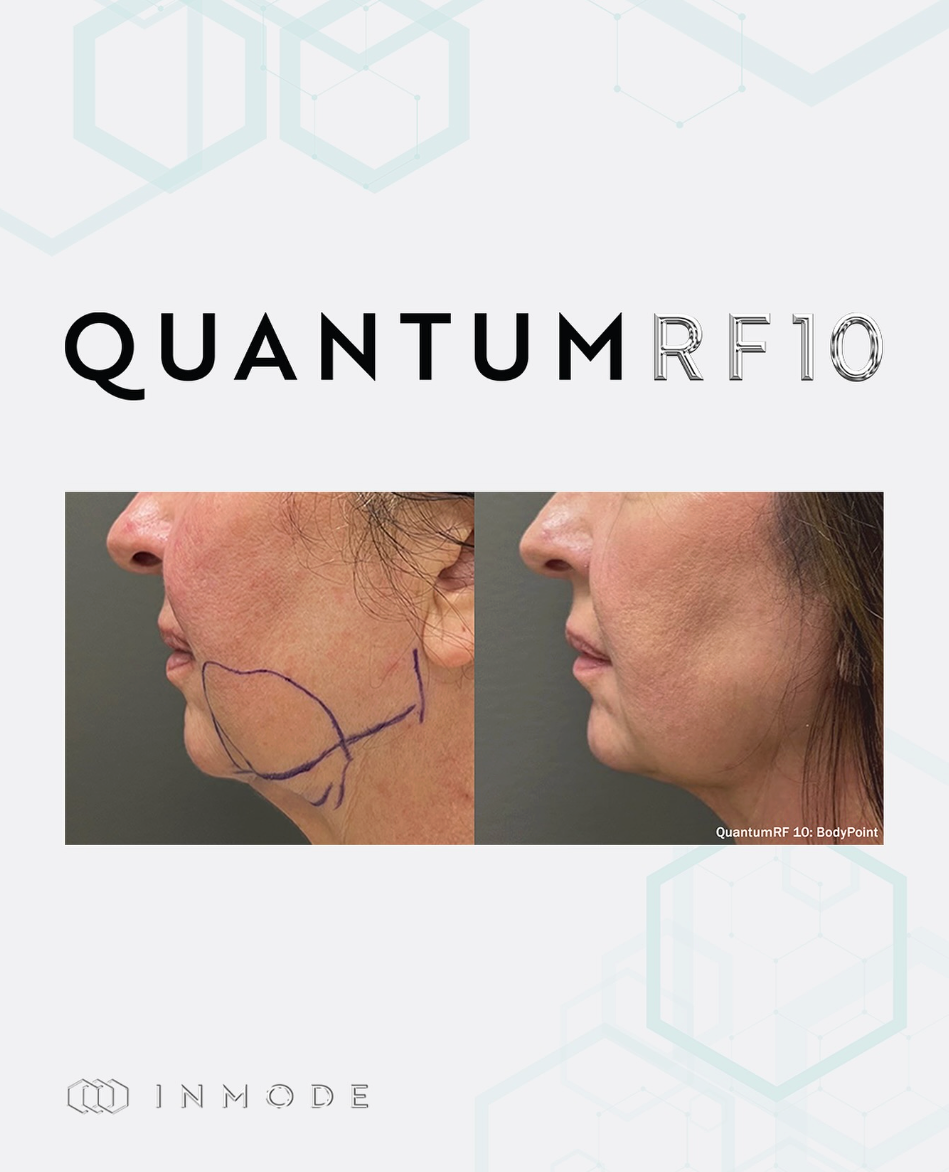 QuantumRF 10 - Small Areas