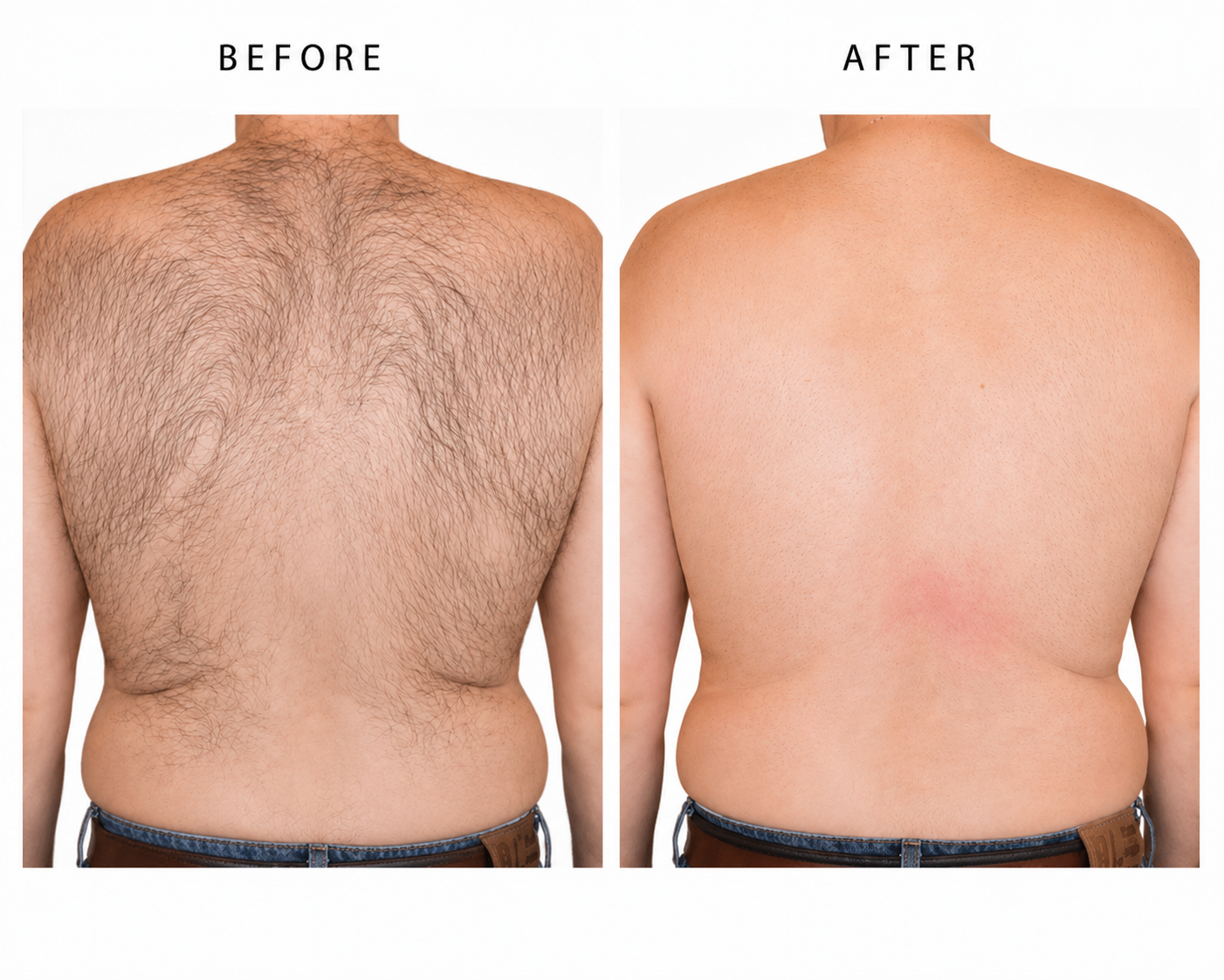 Side-by-side comparison of a man's back before and after hair removal treatment, showing reduced hair and smoother skin in the after photo.