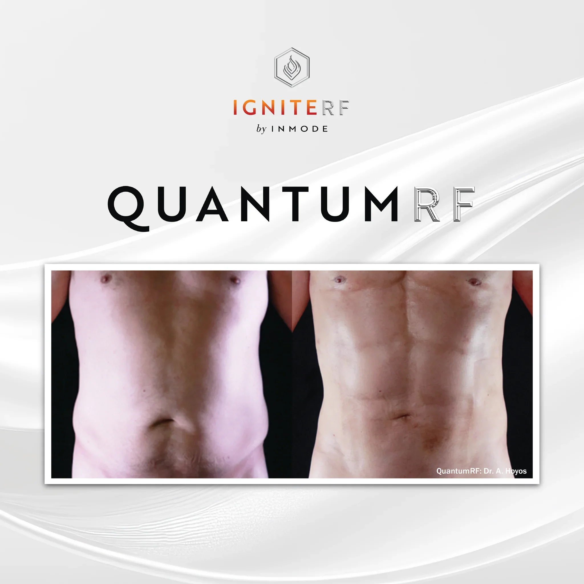 QuantumRF 25 - Large Areas
