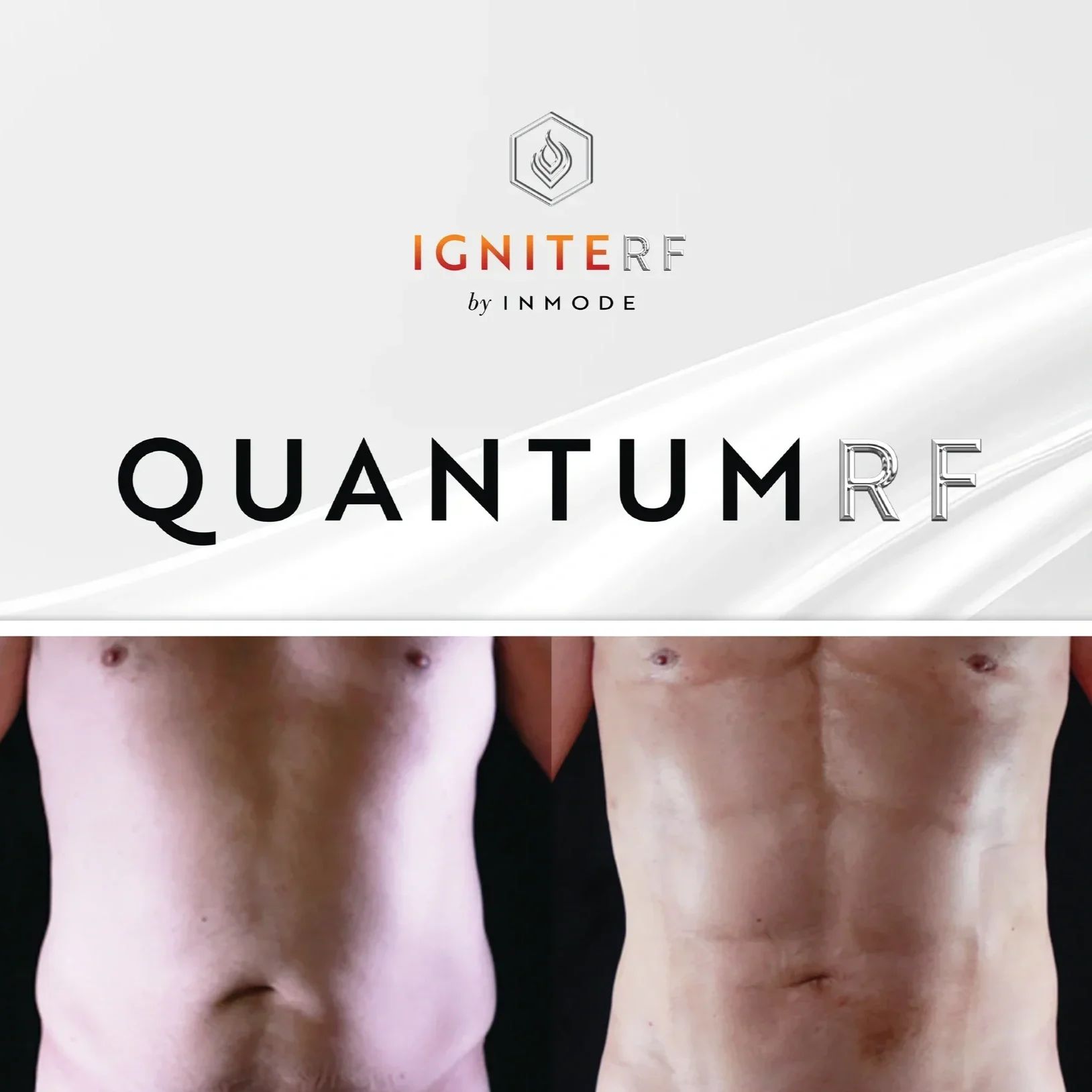 QuantumRF_BeforeandAfters_Male_Abdomen.webp