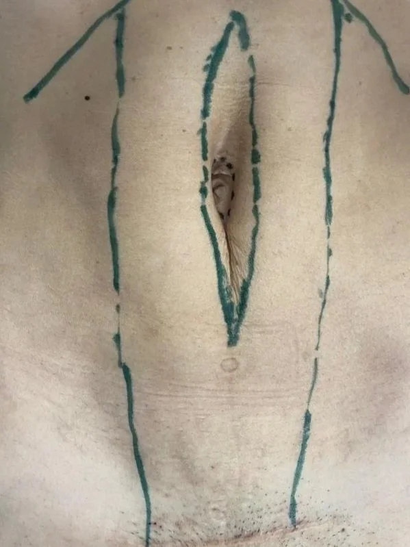 Un agujero en la piel con líneas azules trazadas alrededor, parece un procedimiento quirúrgico o marca para una operación.