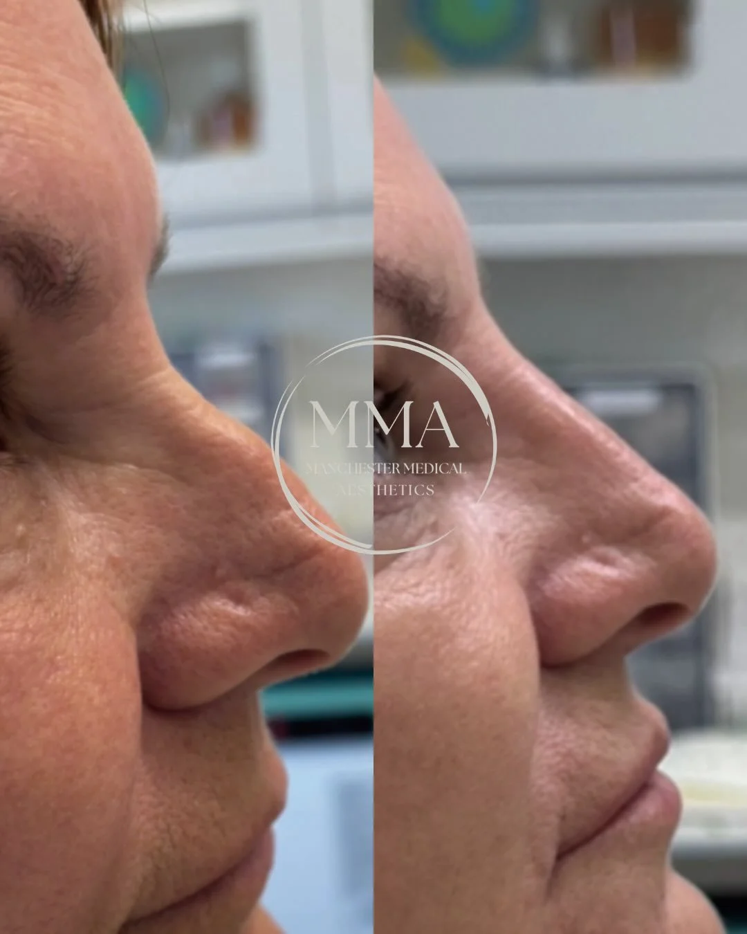 No rhinoplasty? No problem. 👃✨

With strategic nose filler, we can refine the bridge, lift the tip, and create a smoother profile. All without surgery, scars, or downtime.

Sometimes, you don&rsquo;t need the operating room, you just need the right 