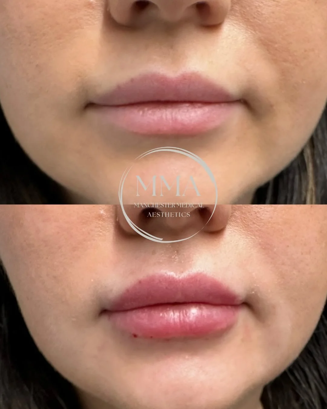 Valentine&rsquo;s Day wish list: 💌
Not roses. Not chocolate. Just a little 💉✨

We make sure to always provide the most natural looking results, no overfilling here.

#lipfiller #valentines #aesthetics #manchesteraesthetics #medicalaesthetics