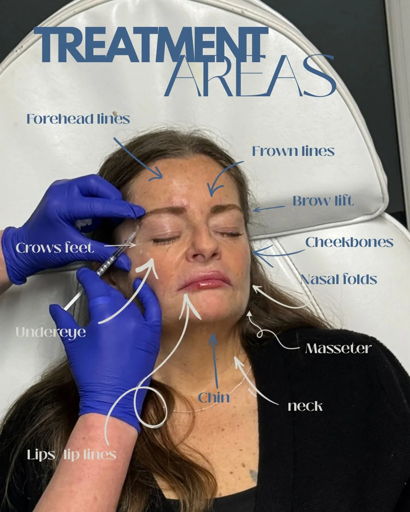 Ever wondered what areas can be treated with aesthetic treatments? Here&rsquo;s just a few&hellip;

From softening finer lines in the forehead and around the eyes, to restoring volume in the cheeks and lips, treatments can be tailored to enhance your