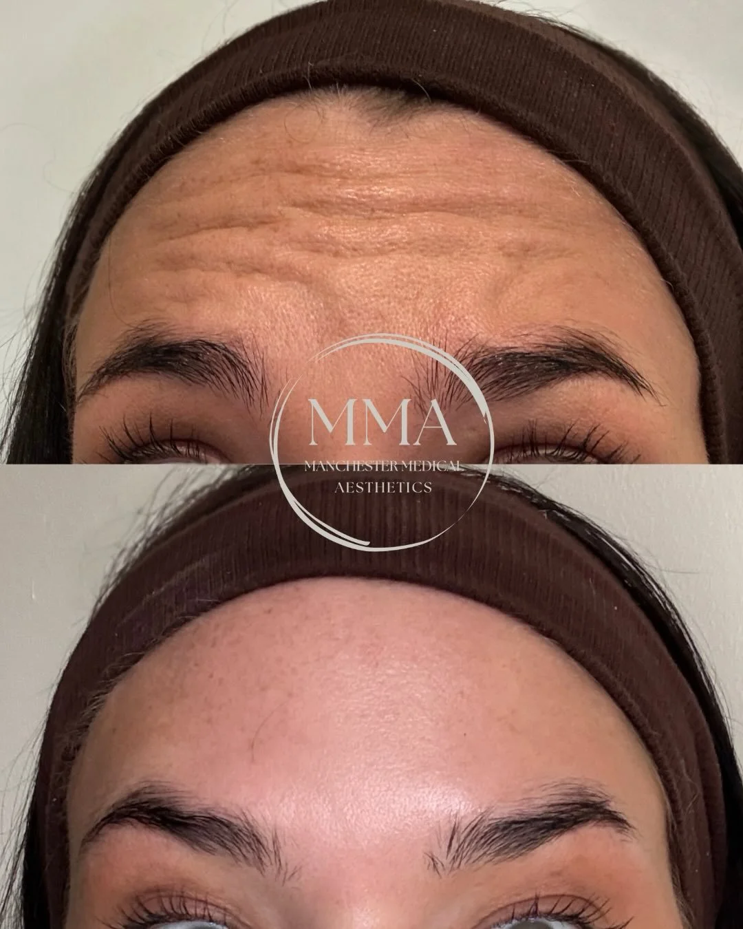 We told you the results were worth it&hellip;

Same expression in both pictures, HUGE difference.

Want the same flawless results? Drop us a DM. 🤎

#antiwrinkle #beforeandafter #frownlines #eyebrowlift #manchesteraesthetics