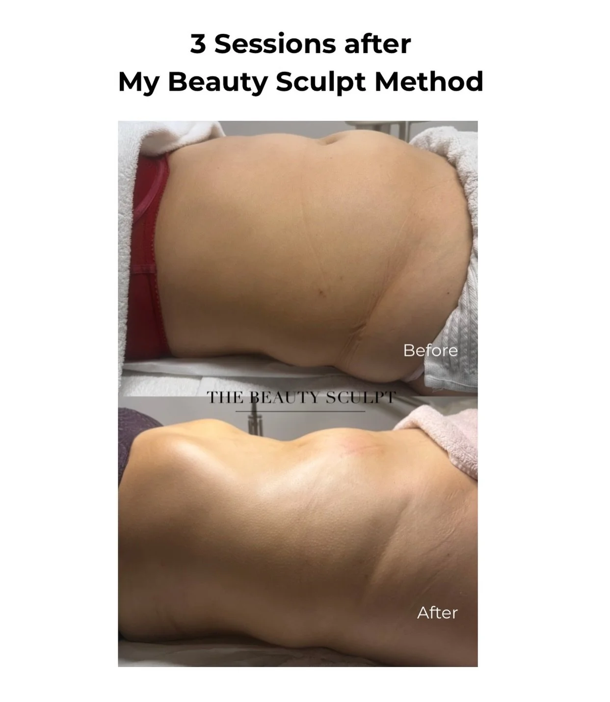 This result was achieved with my My Beauty Sculpt Method, a personalised body contouring approach designed to help reduce fluid retention, improve body definition, and enhance natural shape through targeted techniques.

At The Beauty Sculpt in Nottin