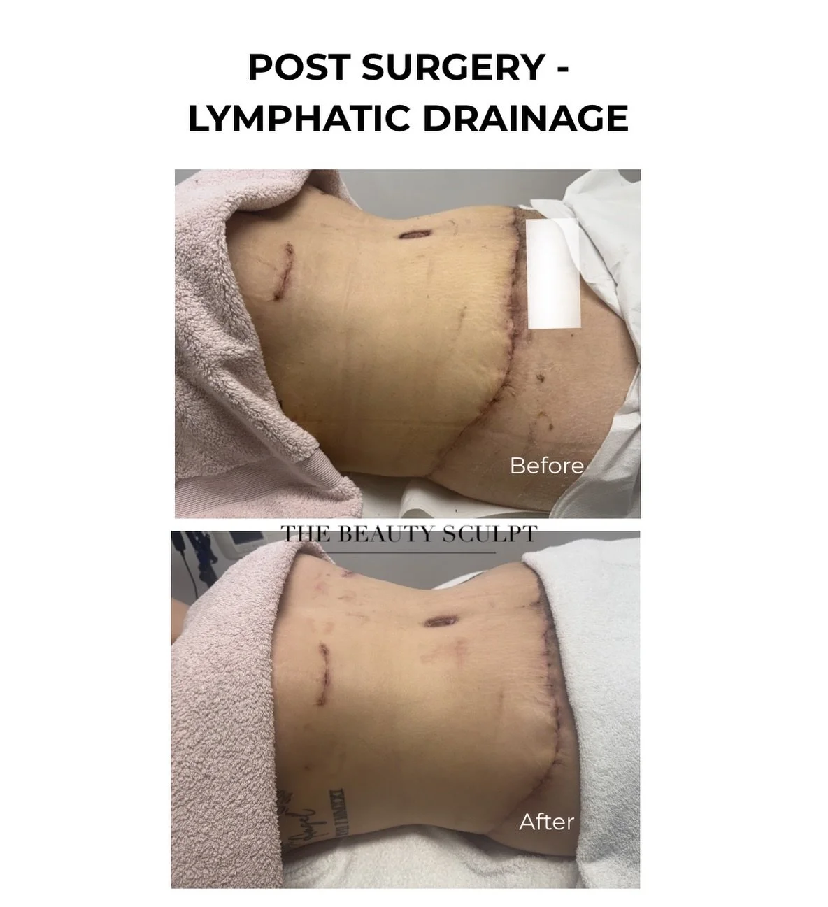 Surgery is only step one&hellip; recovery is everything.
After procedures like liposuction or tummy tuck, the body holds fluid, inflammation builds up and the lymphatic system slows down. This is why many clients experience hardness, swelling and dis