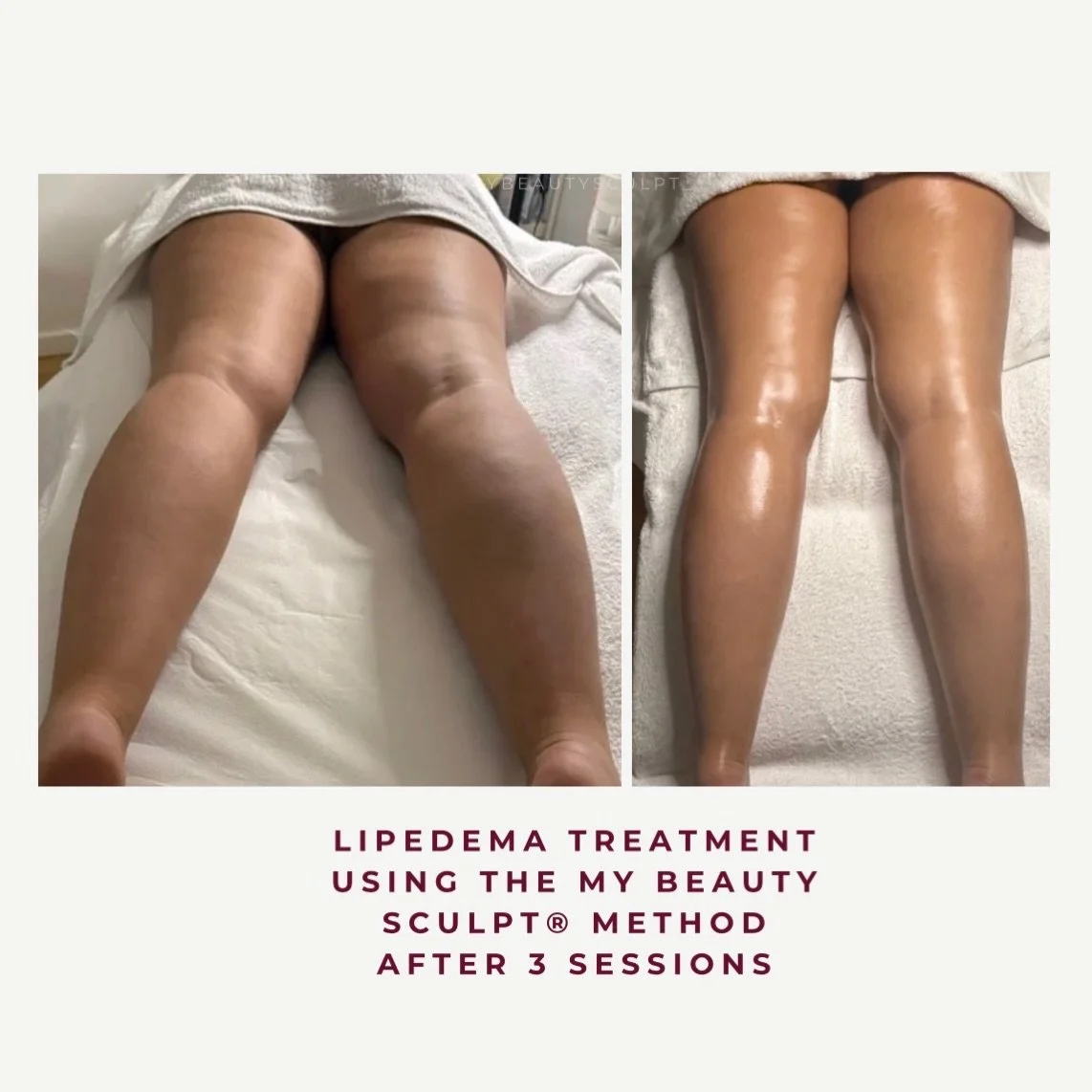 Lipedema is not just size, it&rsquo;s inflammation, heaviness and discomfort.

This lovely client is currently halfway through my structured protocol, designed to support lymphatic flow, reduce fluid stagnation and gradually improve tissue texture.

