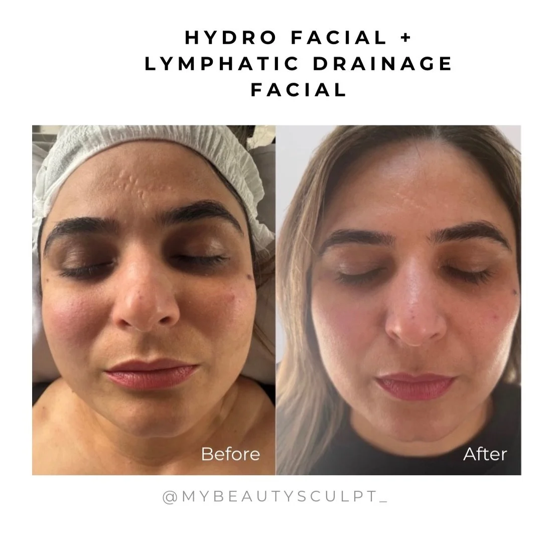 This is why I combine treatments.
It&rsquo;s not about doing more, it&rsquo;s about doing it properly. 🩷

Ready to give your skin what it actually needs?

If you&rsquo;d like to book, just send me a message or use the link in bio. 🤍