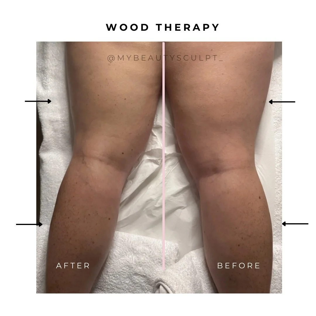1 session. Wood Therapy

This is what happens when you stimulate the lymphatic system properly and sculpt with intention.

Less fluid retention.
More definition.
A smoother contour, especially around the knees and calves.

Wood Therapy is not about i
