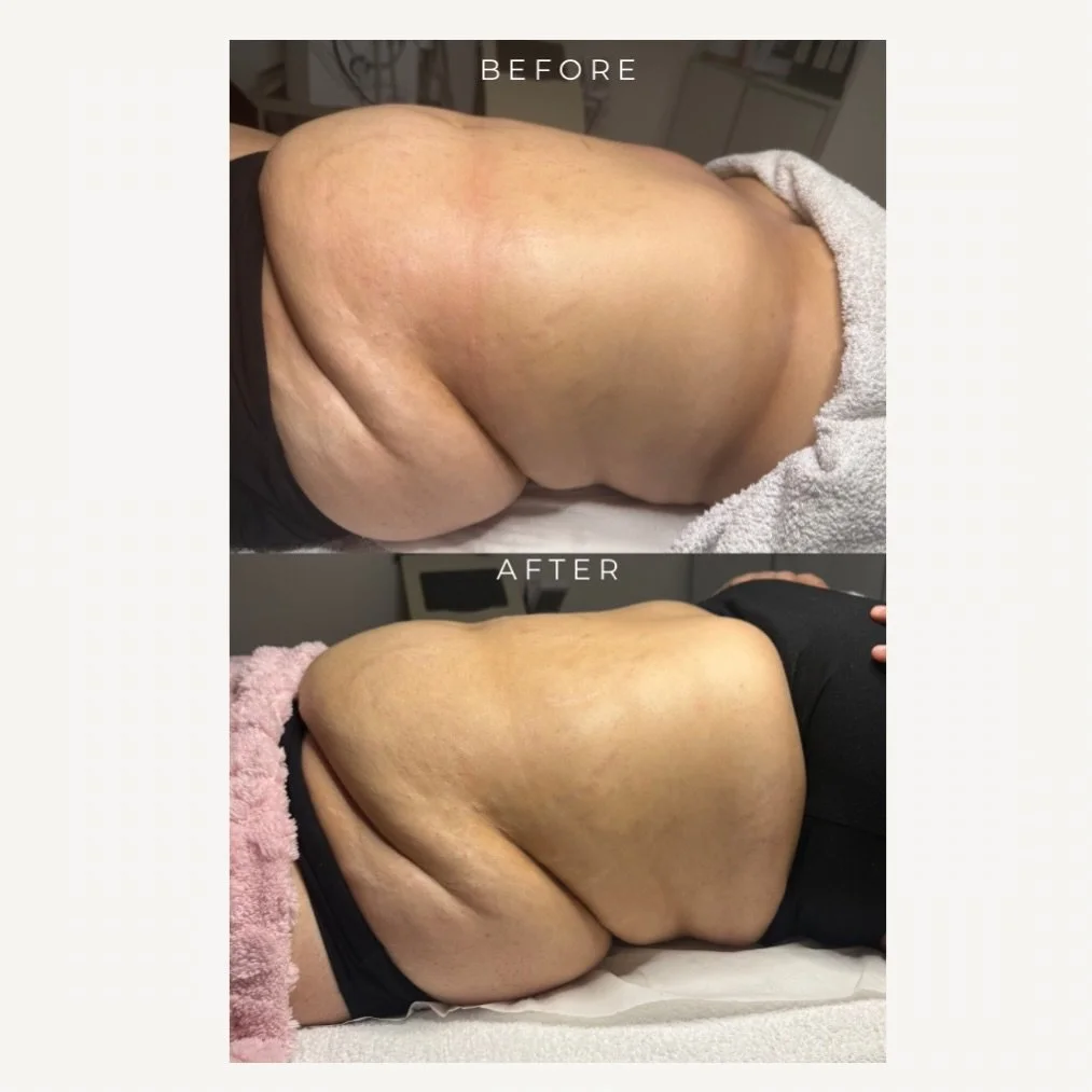✨ Progress after 2 sessions

With My Beauty Sculpt Bespoke Contouring Method, tailored sculpting experience designed around your body.

I combine advanced body contouring, wood therapy and lymphatic techniques to reduce fluid retention, smooth skin t