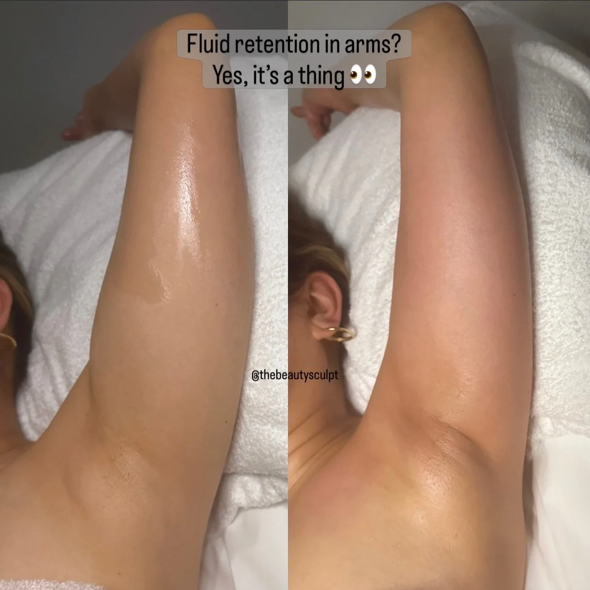 Did you know we can retain fluid in our arms too? 👀

This is why lymphatic drainage can make such a visible difference, even in areas we don&rsquo;t always think about.

After working through the arm, you can often see the fluid moving towards the u