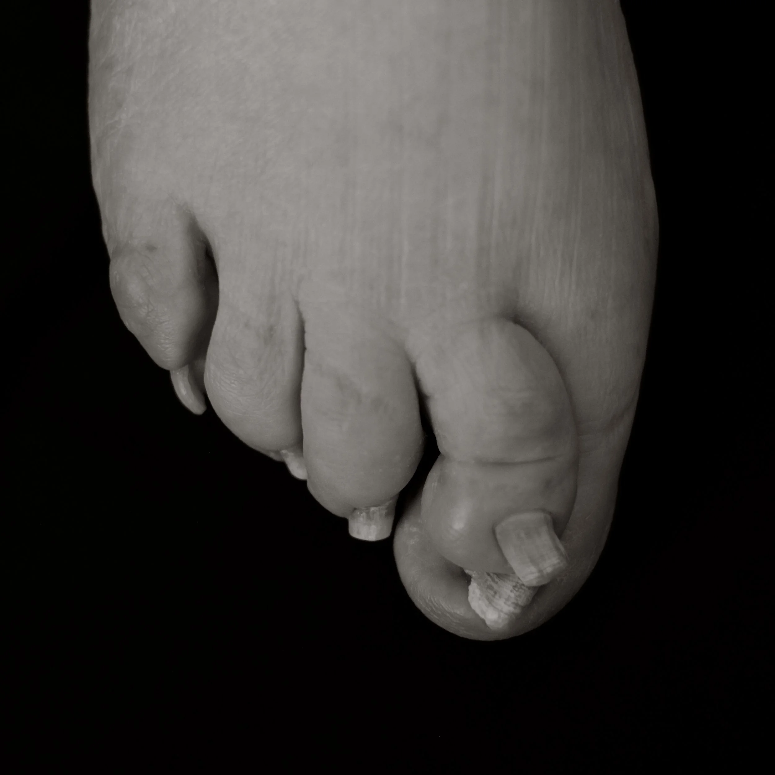 Black and white close-up of an elderly person's foot, showing toes with bent and chipped toenails against a dark background.
