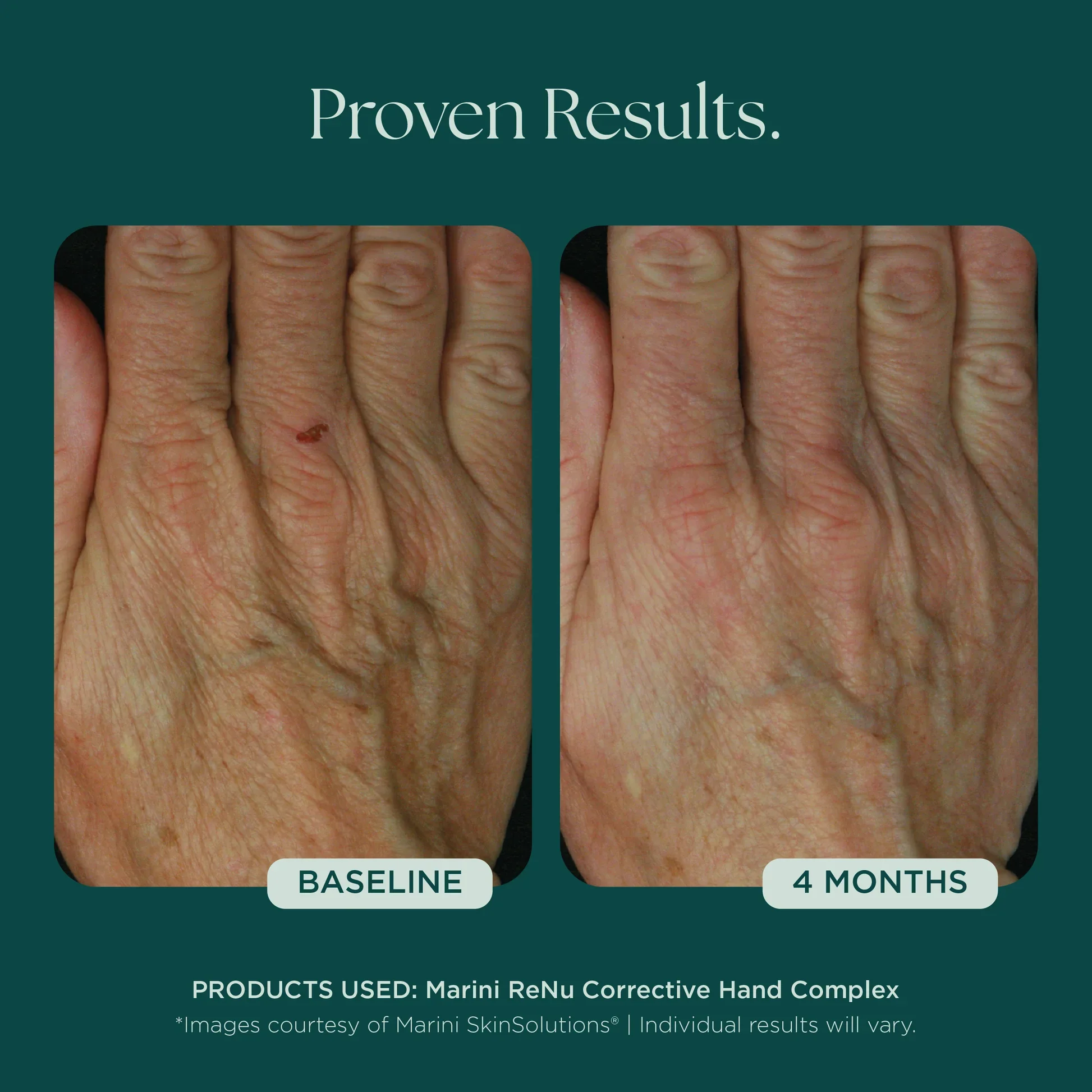 Marini_Corrective_Hand_Complex_Before_Afters_042726__HANDS-Renu-01.webp