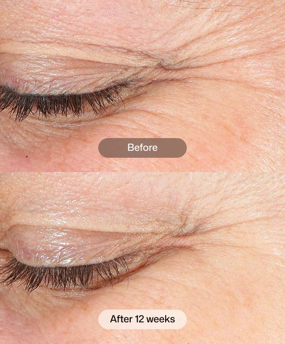 Revision-revox-line-relaxer-before and after.webp