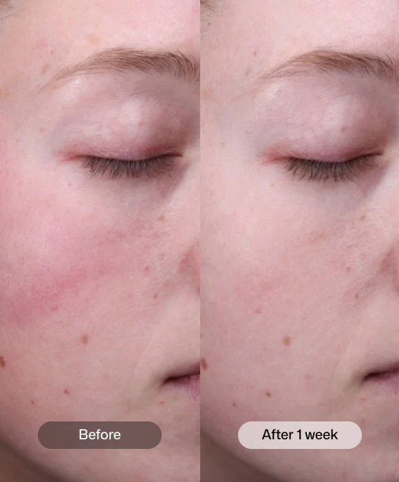 Revision-radiance-resurfacing-serum-before-and-after.webp