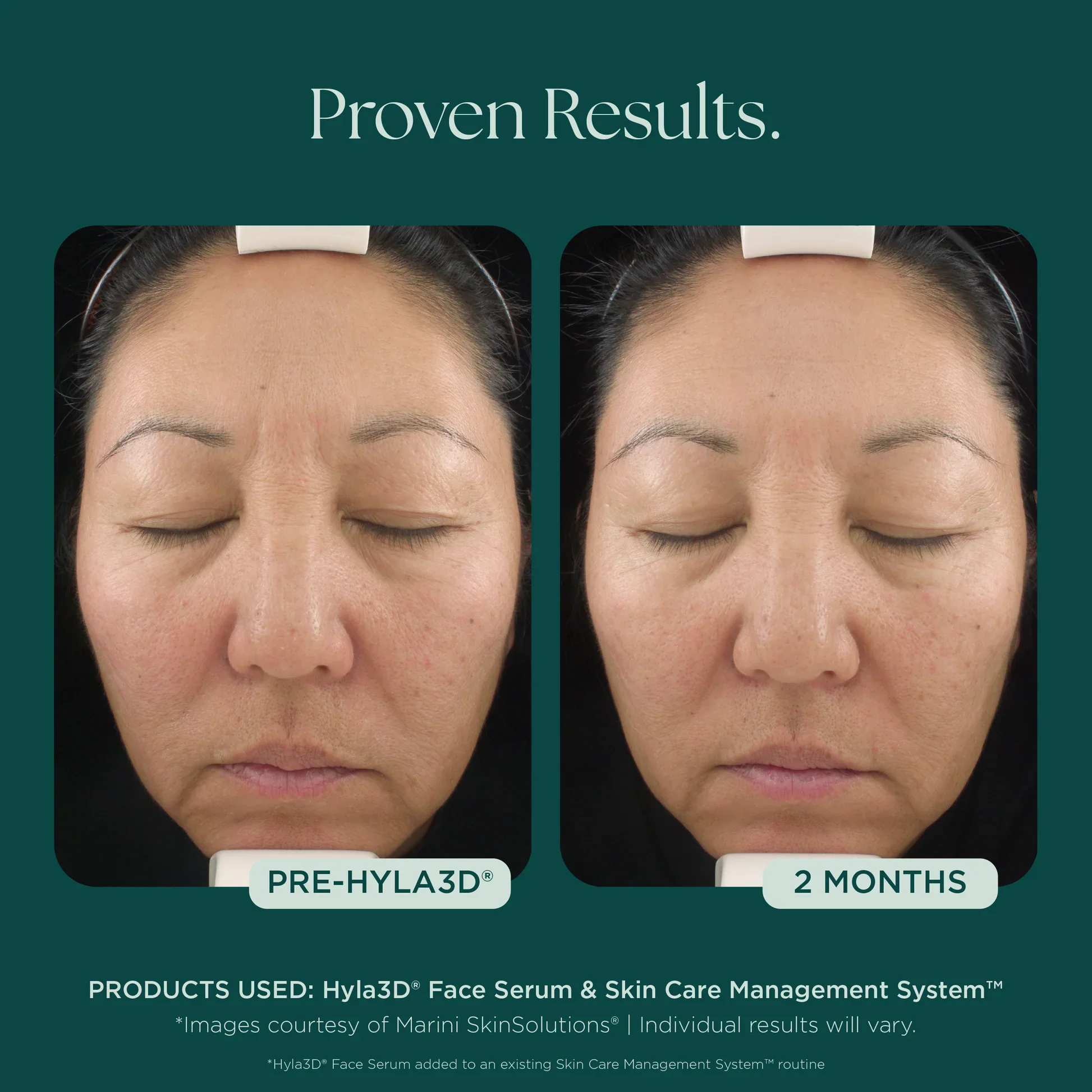 Meraki Marini Before_Afters_Hyla3DSerum-1.webp