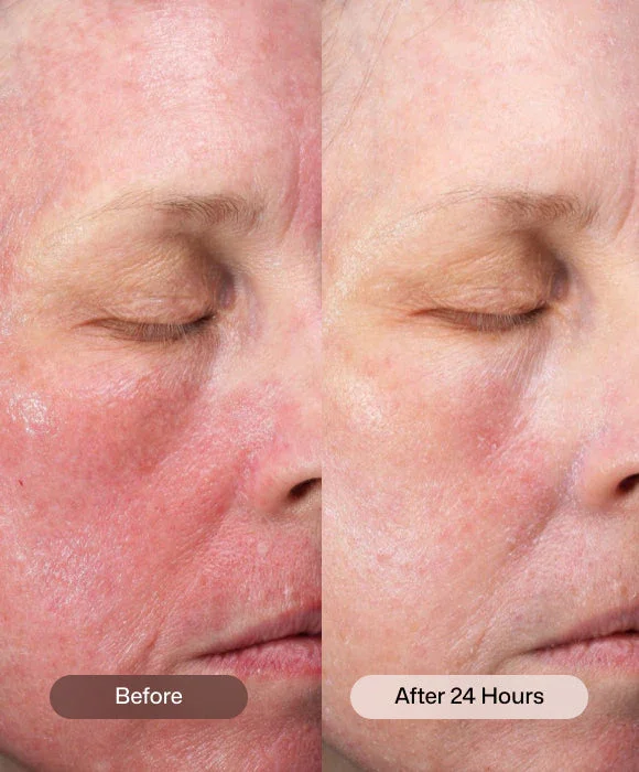 Meraki Revision cmt-post-procedure-cream Before After.webp