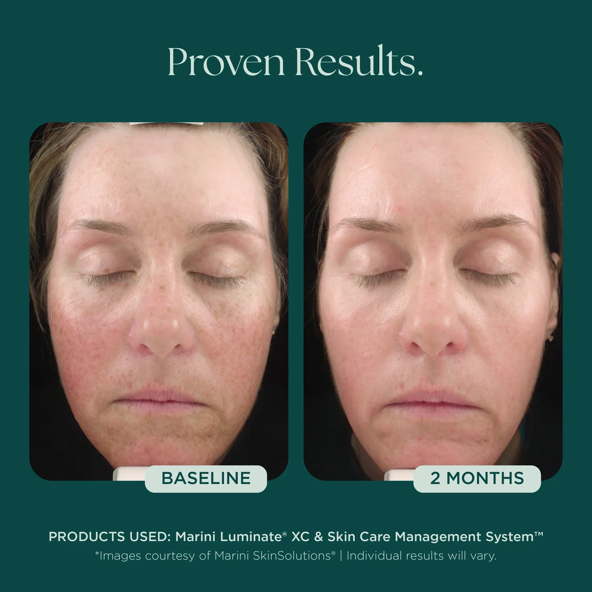 Marini_Before_Afters_DISCOLORATION_042726__DISCOLOR-8006_Meraki.webp