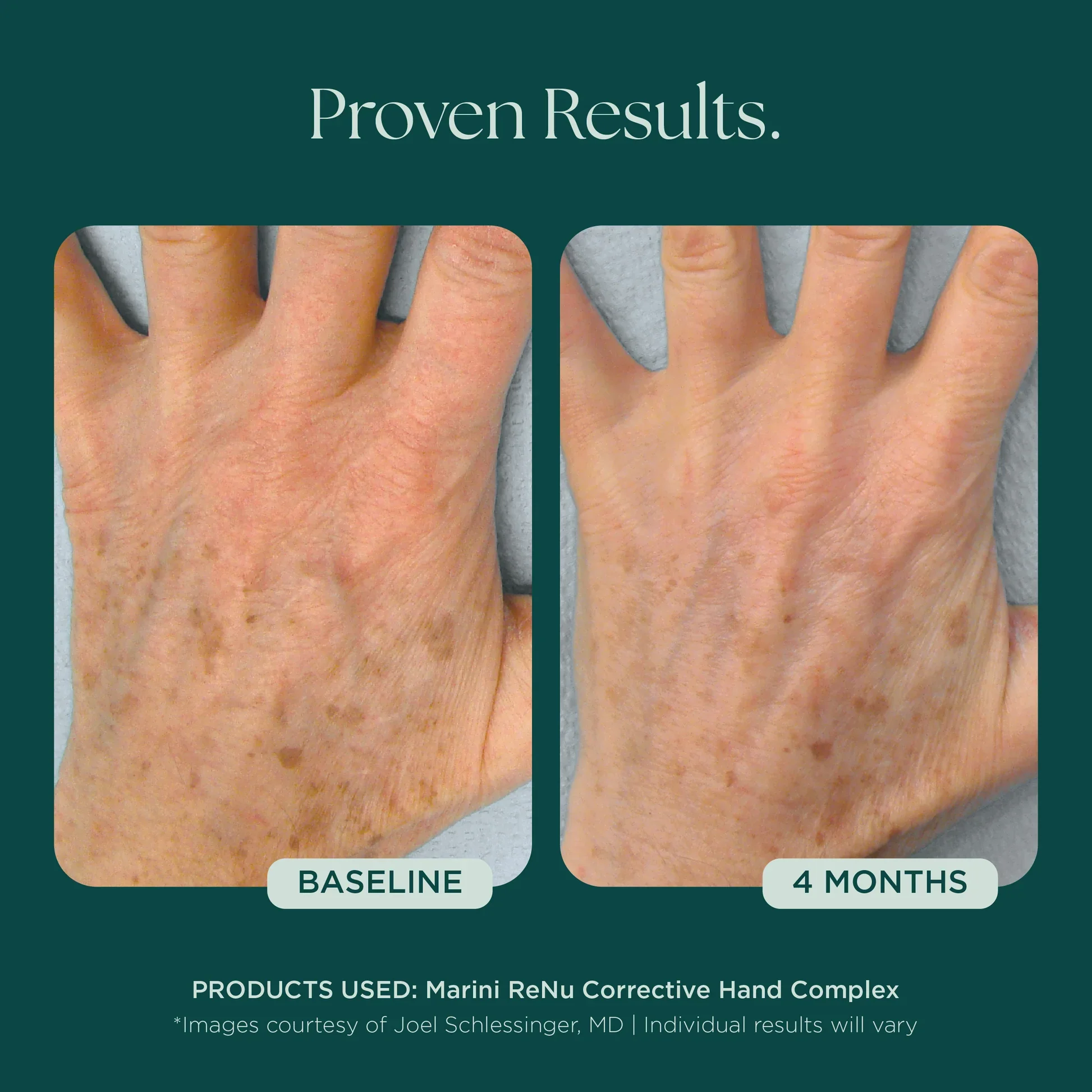Marini_Corrective_Hand_Complex_Before_Afters_042726__HANDS-Renu-02.webp