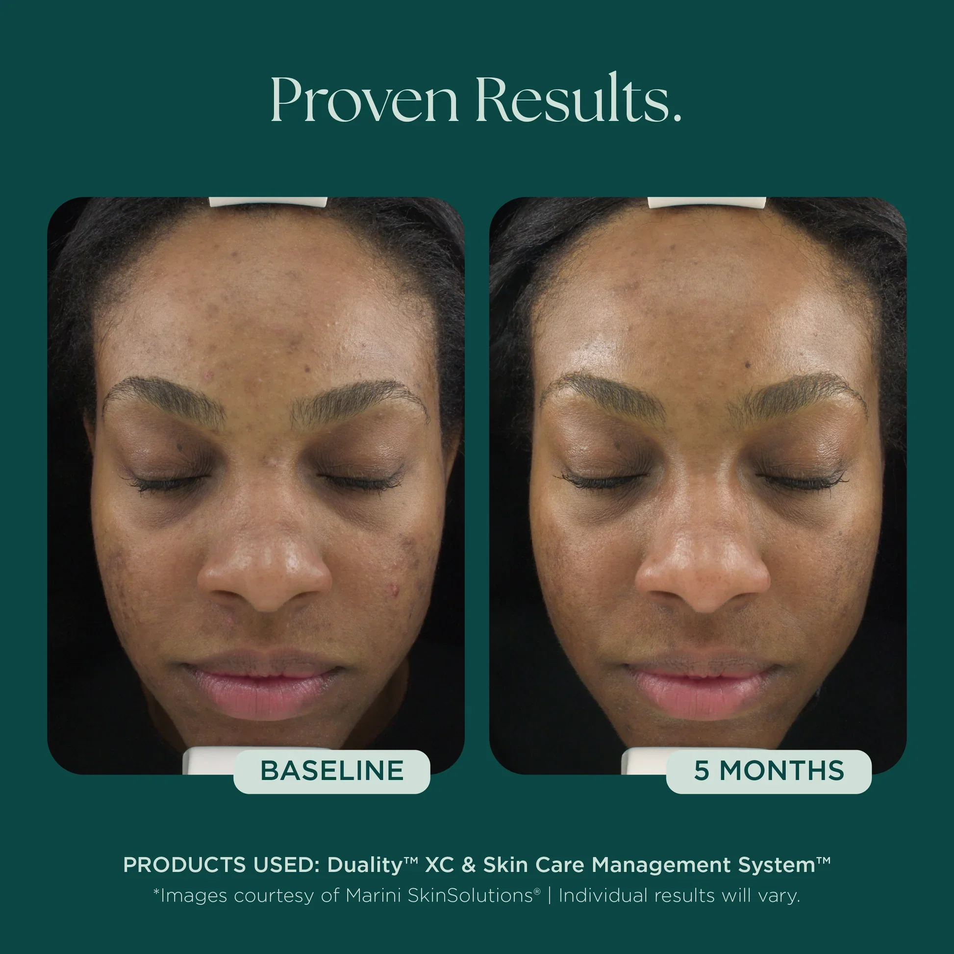 Meraki Marini_Before_Afters_ACNE_042726__ACNE-DualityXC.webp
