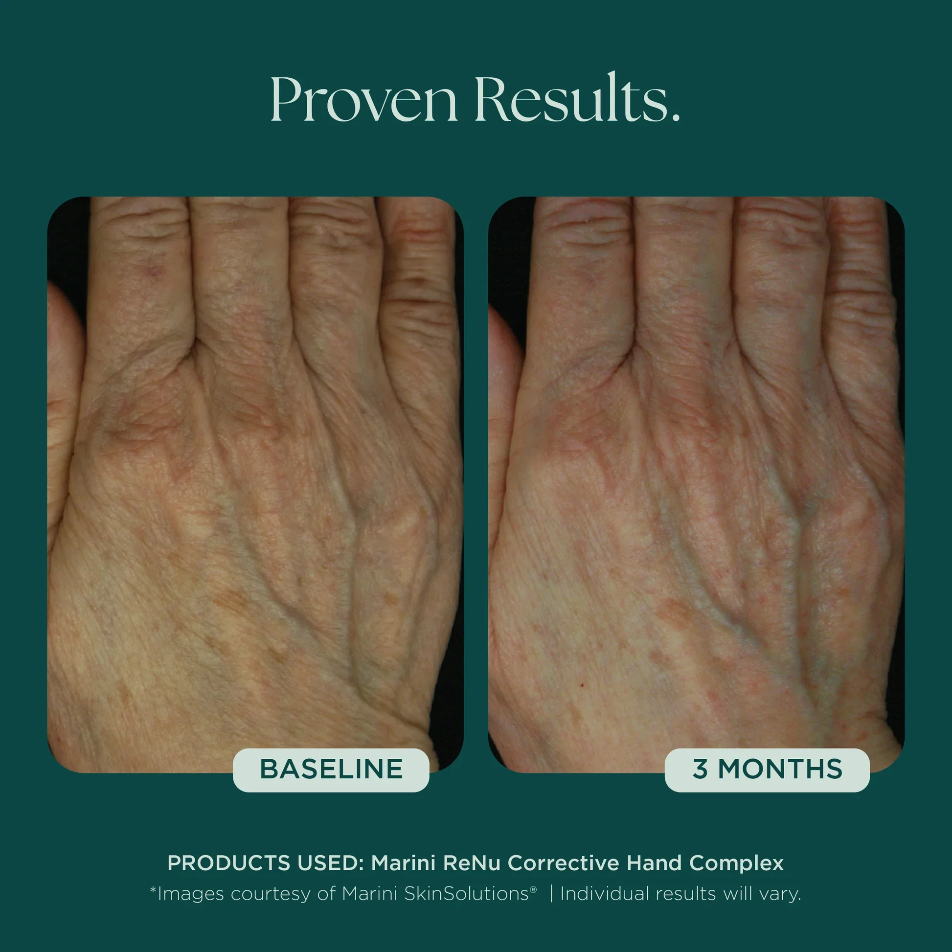 Marini_Corrective_Hand-Complex_Before_Afters_042726__HANDS-Renu-05.webp
