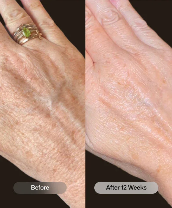 Revision-youthfull-hands-Benefits-Before-and-After.webp