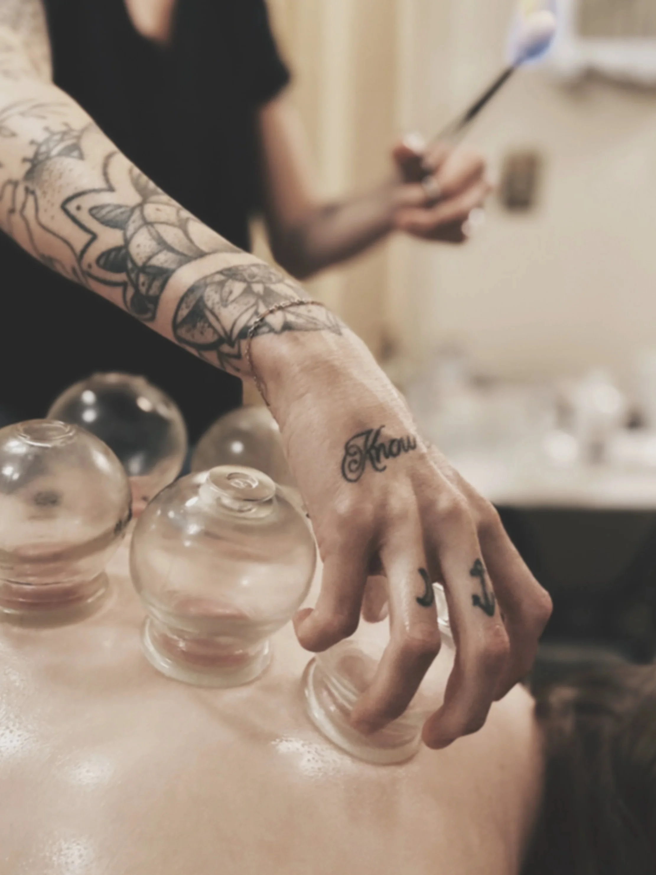 licensed acupuncturist performing cupping therapy in Mount Pleasant SC