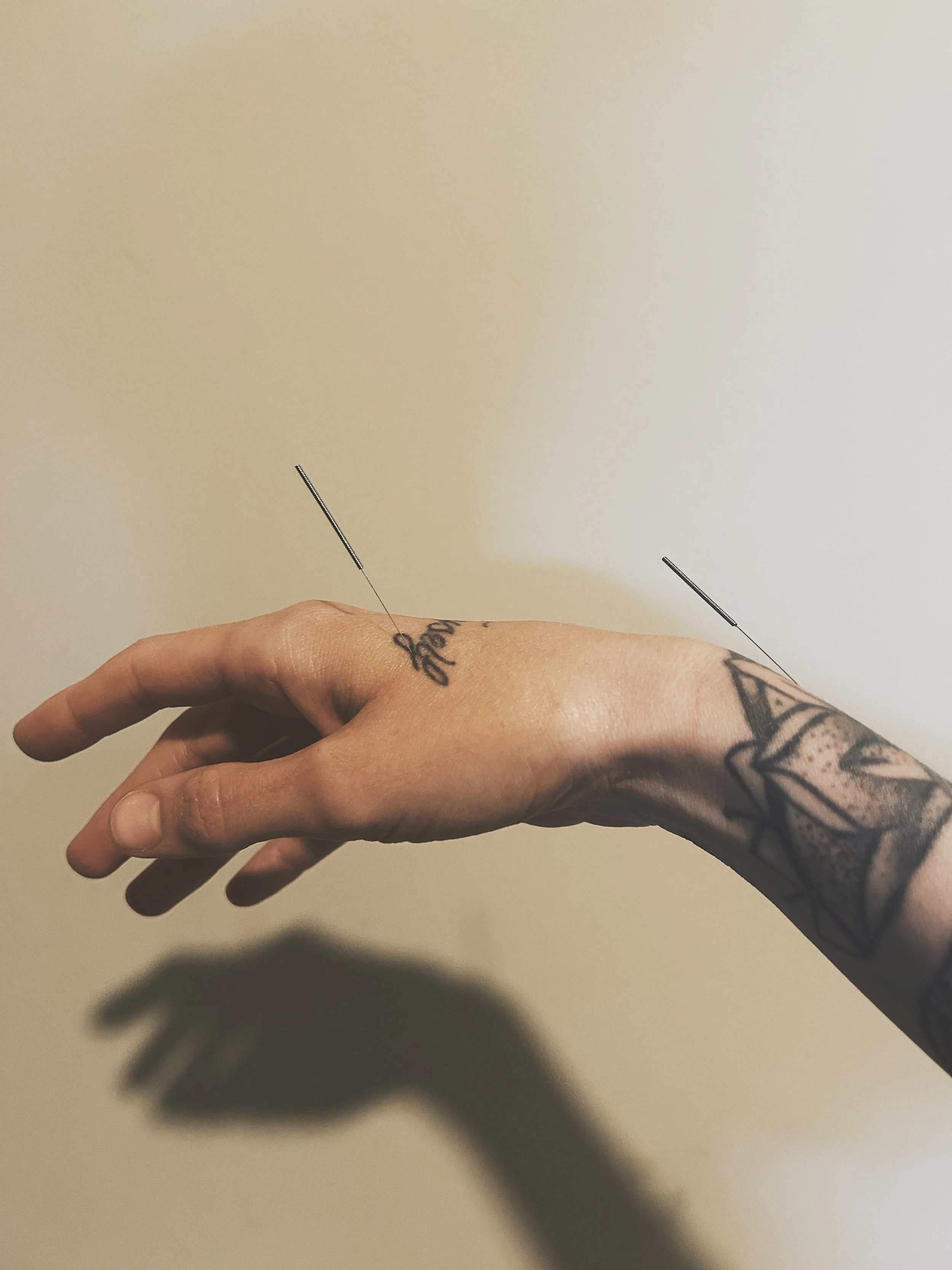 acupuncture needles in hand used for natural pain relief therapy in Charleston, SC