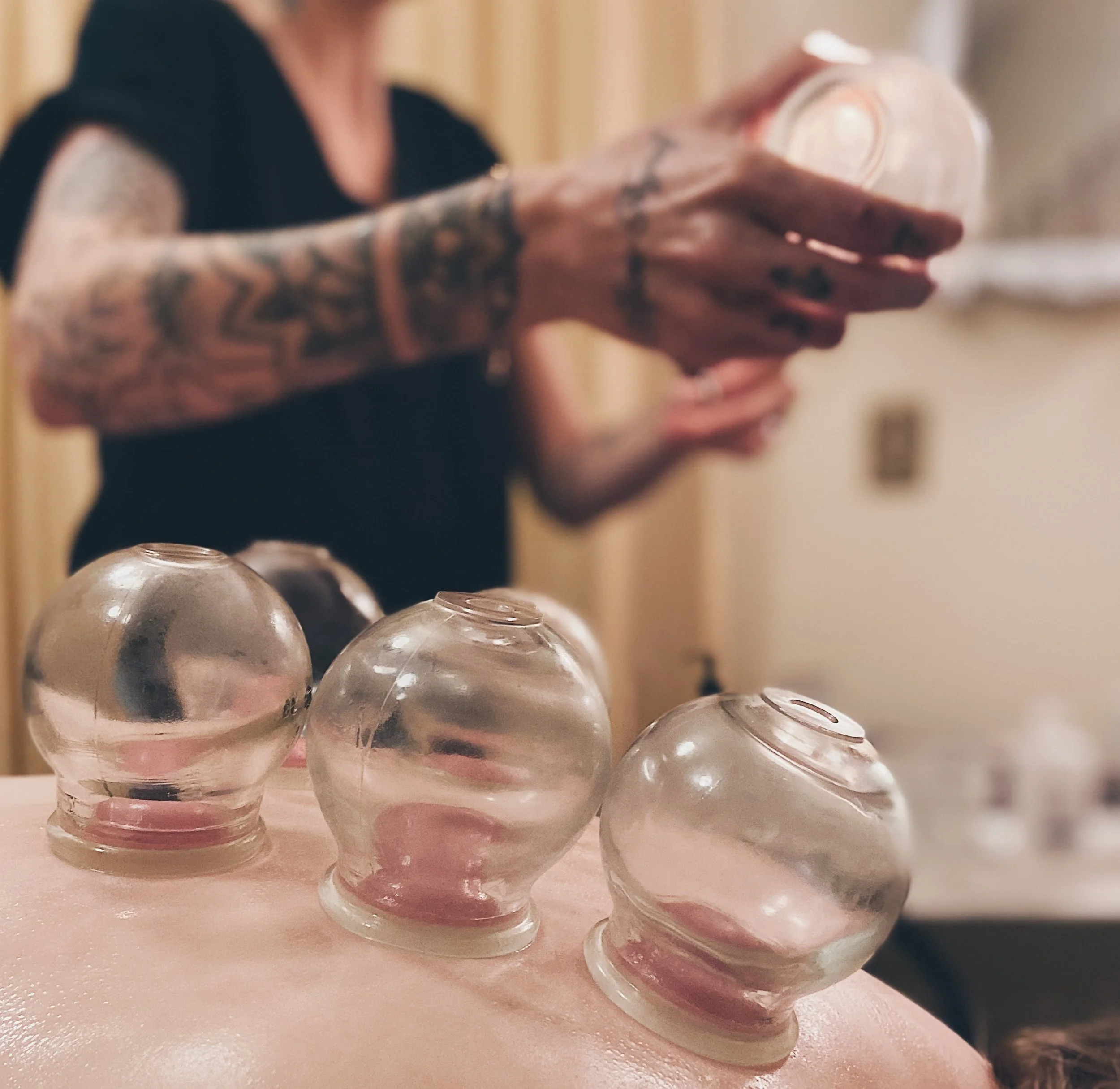 Licensed acupuncturist performing therapeutic cupping on patient for pain relief and muscle relaxation