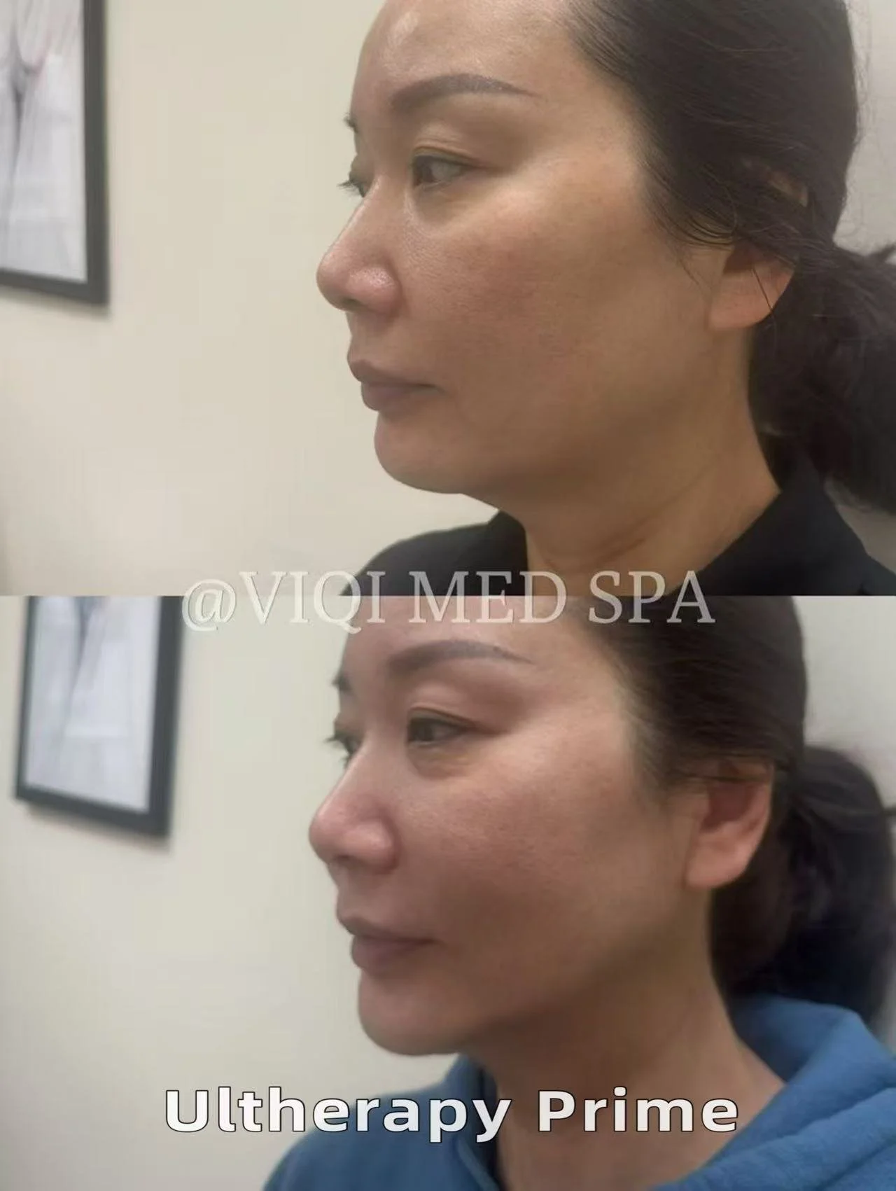 Real VIQI Ultherapy Prime Patient — Before & After. Individual results vary.