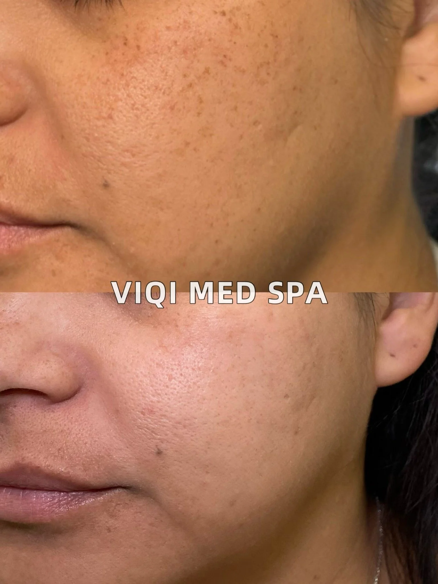 VIQI patient IPL/XPL comparison, side view. Before above and after below. Individual results vary.