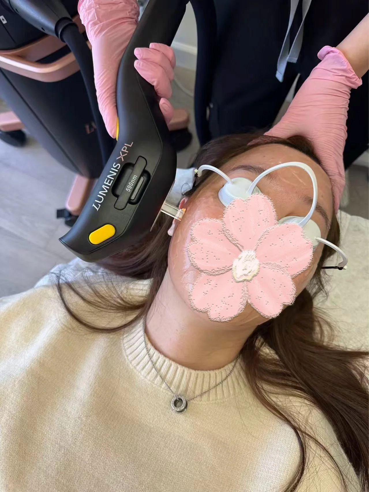 Lumenis XPL treatment in progress at VIQI Med Spa Alhambra. Treatment scene, not a before-and-after result.