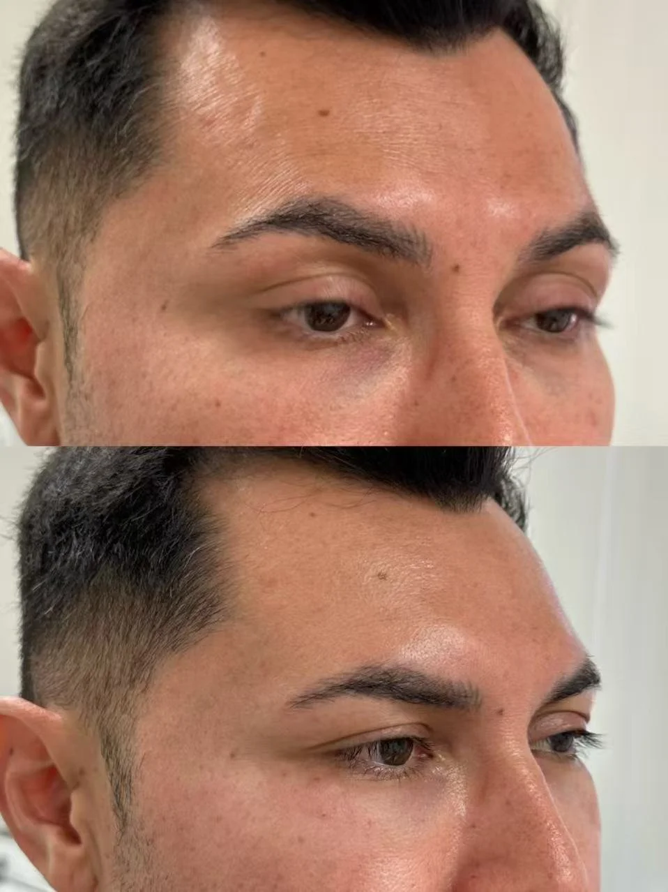 Under-Eye Rejuvenation · VIQI Patient Results