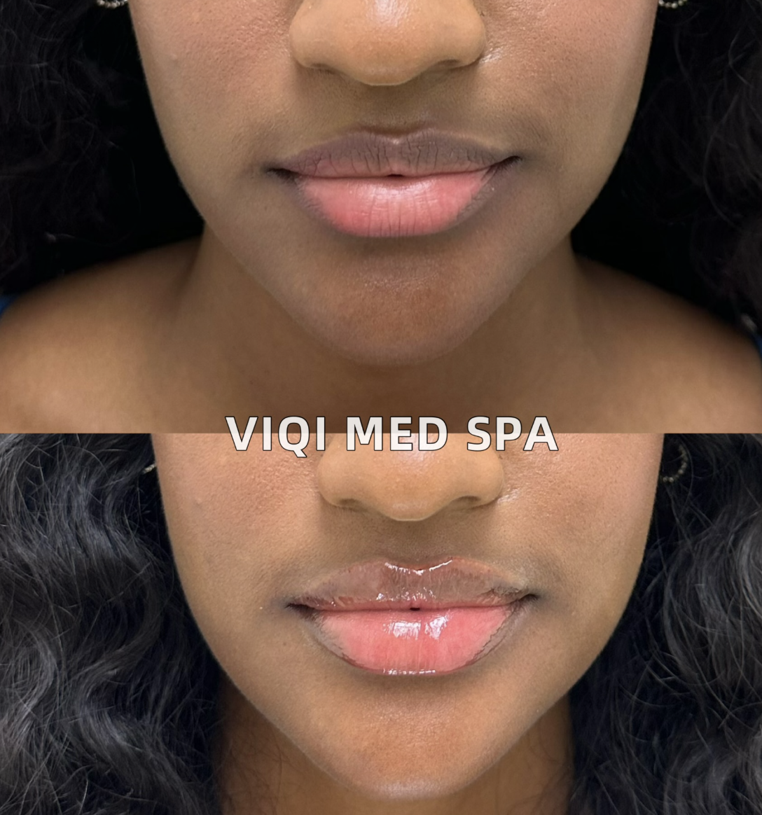 VIQI lip filler comparison, before above and after below