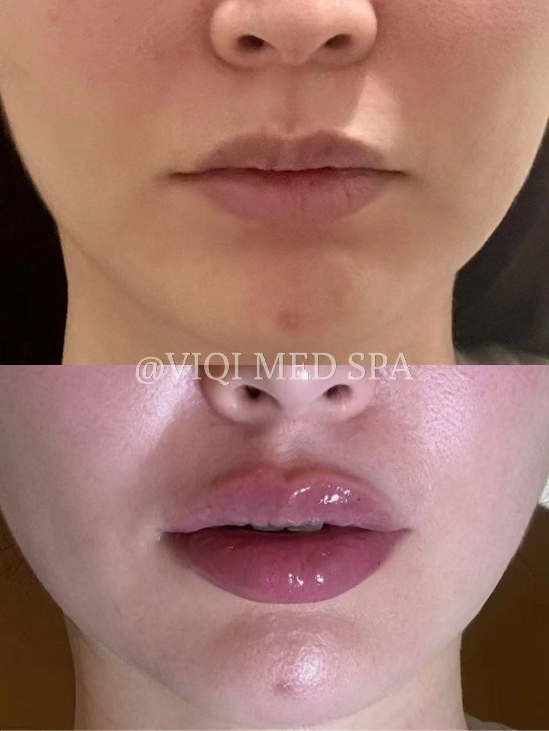 VIQI lip filler patient comparison: before above, after below