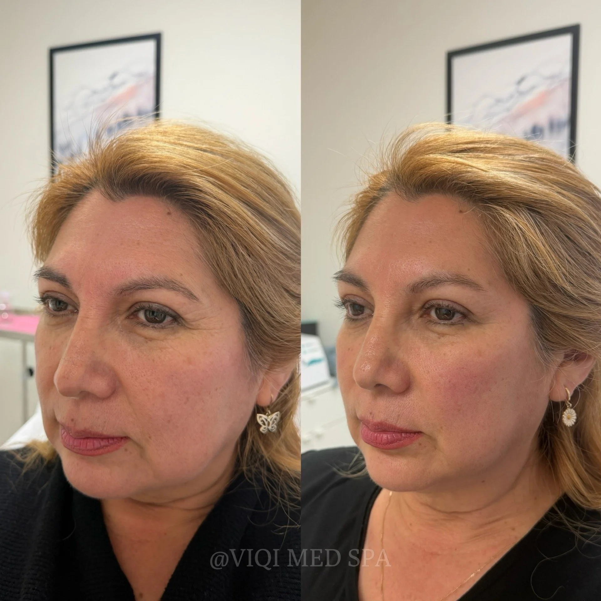 Facial Balancing · Patient Case 01
A personalized approach to facial proportion. Individual results vary.