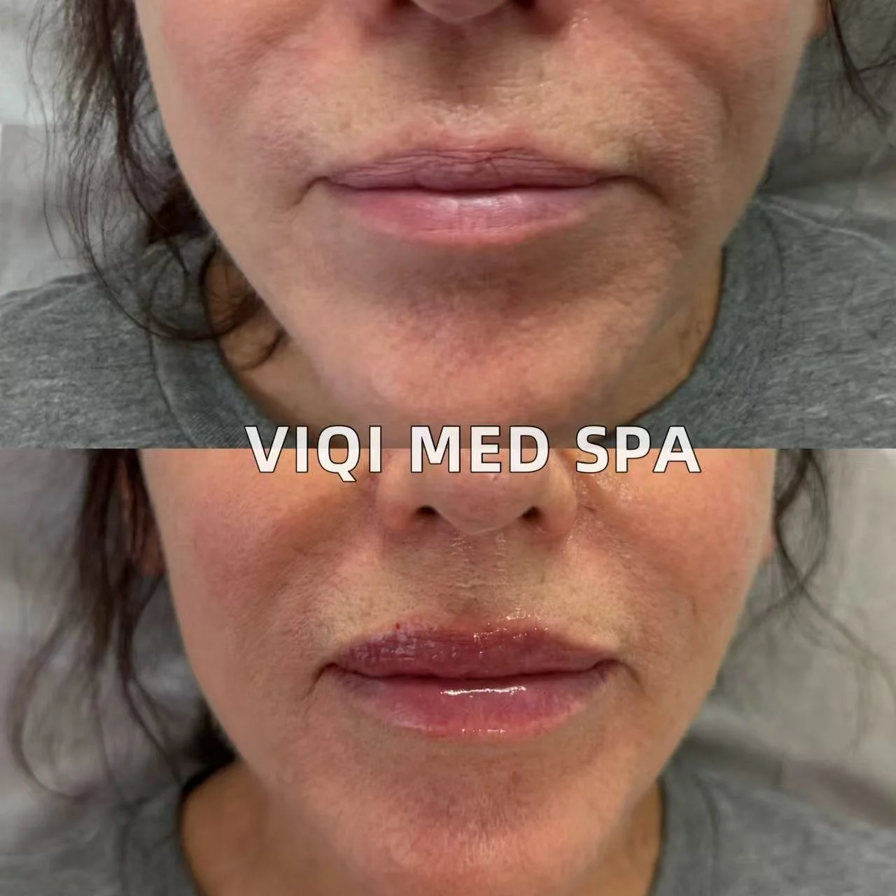 VIQI lip filler patient example 3, before on top and after below