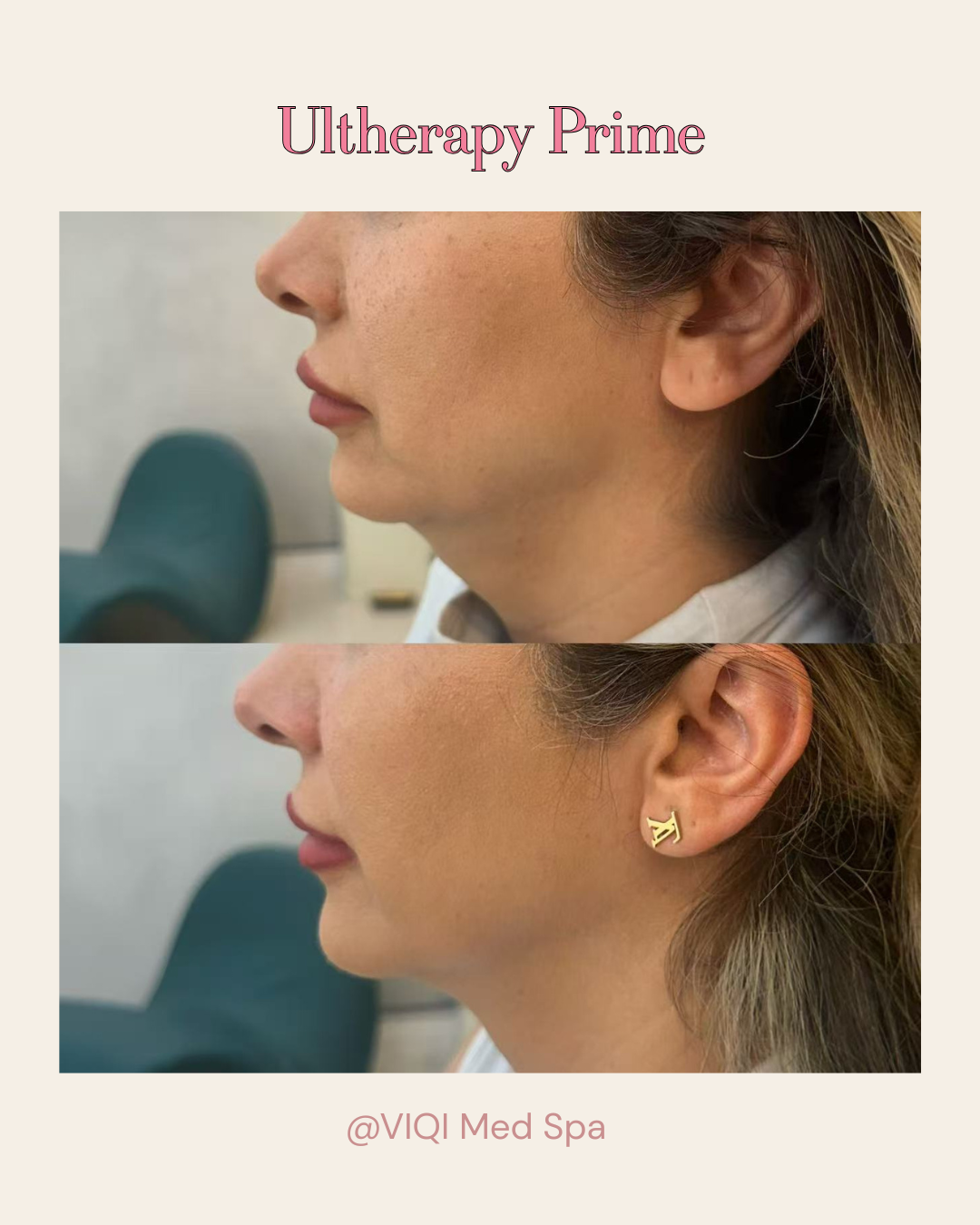 Real VIQI Ultherapy Prime Patient — Before & After. Individual results vary.