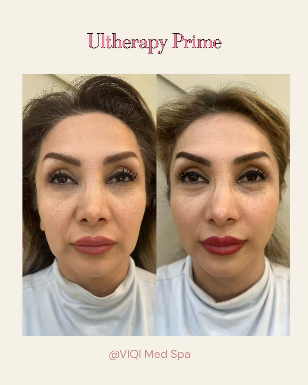 Real VIQI Ultherapy Prime Patient — Before & After. Individual results vary.