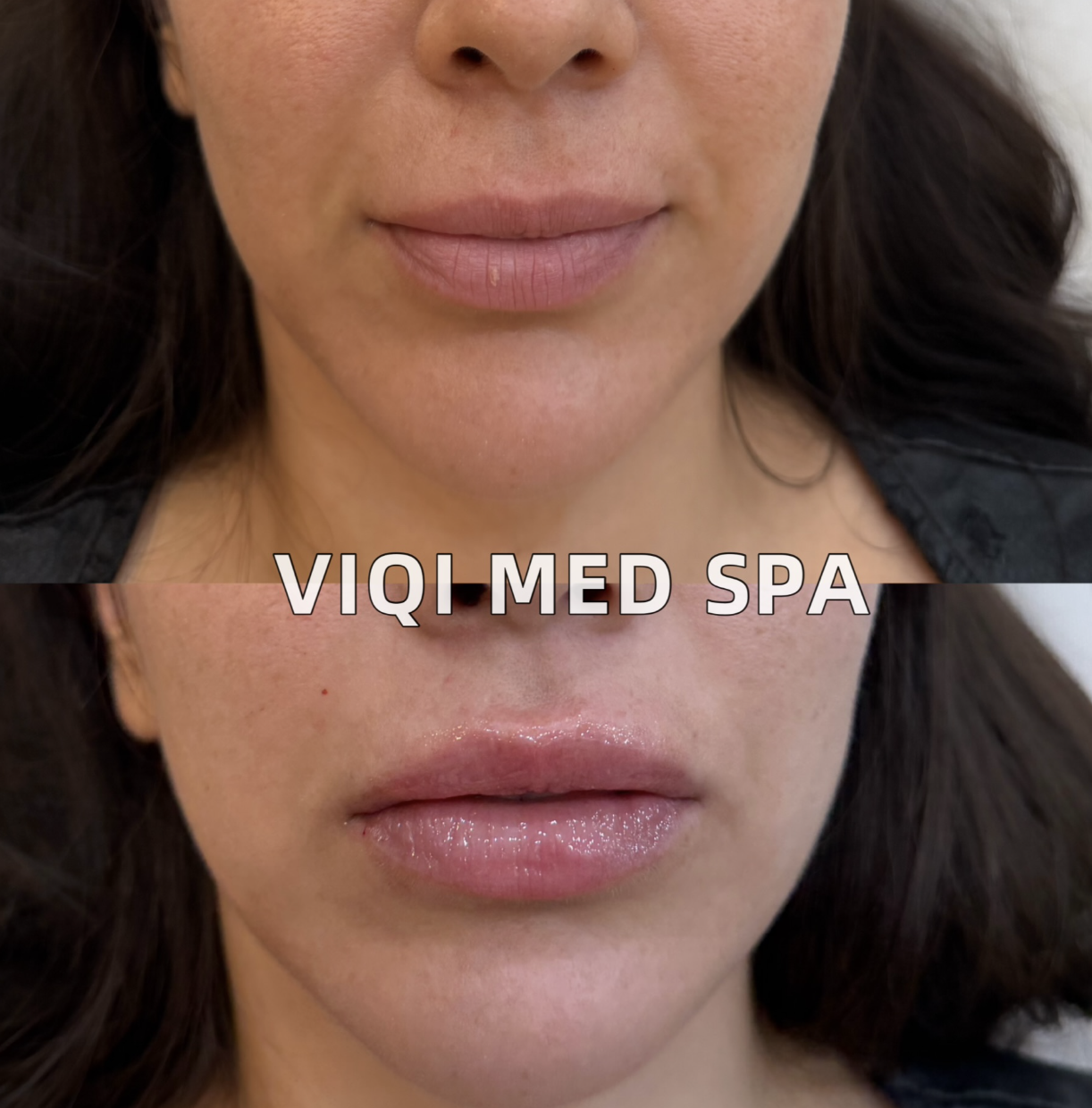 VIQI lip filler patient example 2, before on top and after below