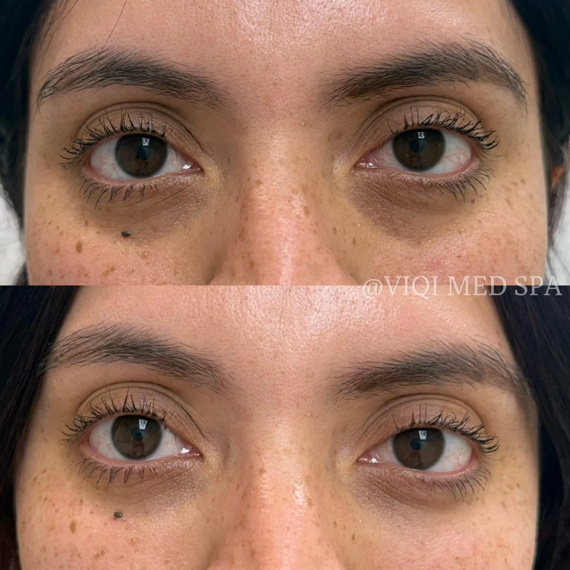 Under-Eye Rejuvenation · VIQI Patient Results