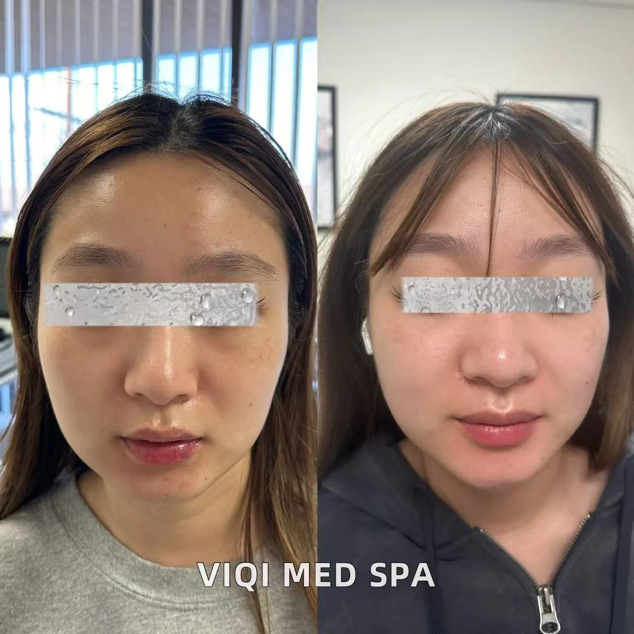 Sculptra · VIQI Patient Results